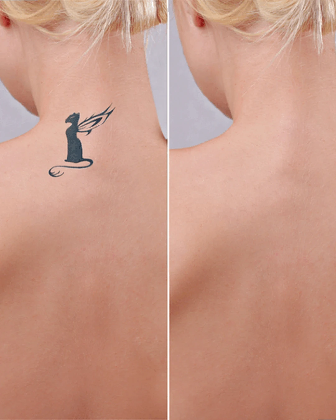 Tattoo Removal